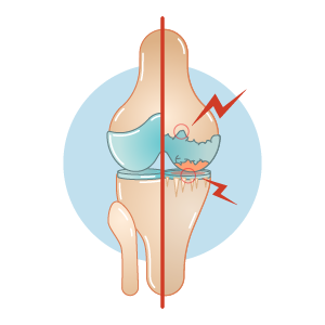 types-of-arthritis-infographic-osteoarthritis