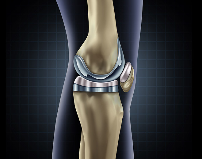orthopedics-knee-replacement