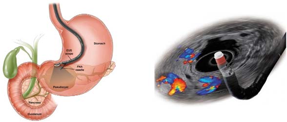 eus-digestive7fe873eaa4f163eda0bfff0b00ed1b39 Endoscopic ultrasound-guided pancreatic biopsy illustration